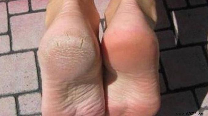 Grandma s Proven Remedy for Smooth, Callus-Free Feet