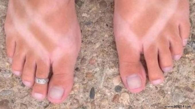 Grandma s Proven Lavender Oil Remedy for Fast Sunburn Relief