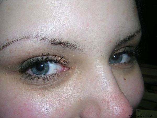 8 Proven Natural Remedies for Dark Circles – My Tried-and-Tested Favorites