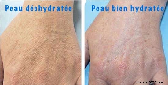 14 Telltale Signs of Dehydration and Proven Ways to Fix Them