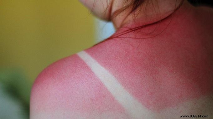 Surprising White Vinegar Remedy: Fast, Natural Sunburn Relief