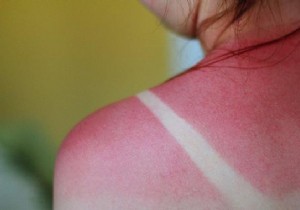 Surprising White Vinegar Remedy: Fast, Natural Sunburn Relief