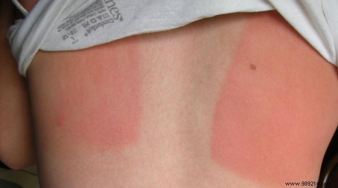 5 Proven Natural Remedies to Soothe Sunburn Fast