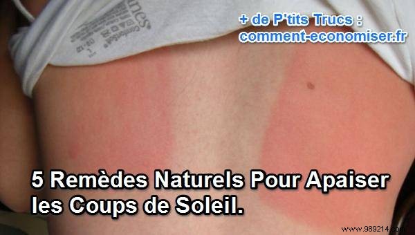 5 Proven Natural Remedies to Soothe Sunburn Fast