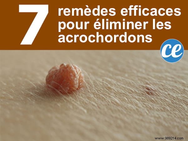 7 Proven Natural Remedies to Safely Remove Skin Tags at Home