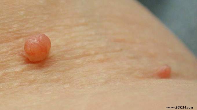 7 Proven Natural Remedies to Safely Remove Skin Tags at Home