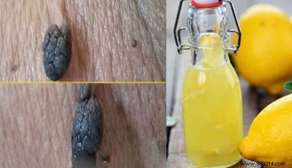 7 Proven Natural Remedies to Safely Remove Skin Tags at Home