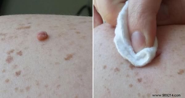7 Proven Natural Remedies to Safely Remove Skin Tags at Home