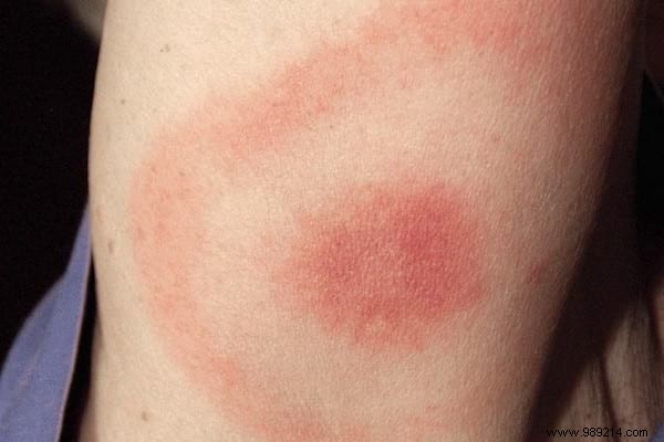 3 Expert Tips to Prevent Tick Bites: ANSES-Recommended Strategies