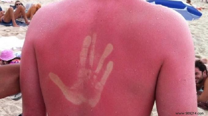 Soothe Sunburn Pain and Redness Naturally with Tomatoes