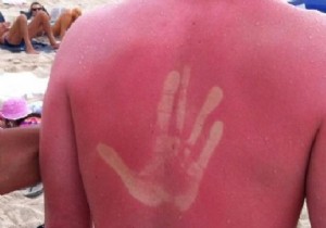 Soothe Sunburn Pain and Redness Naturally with Tomatoes