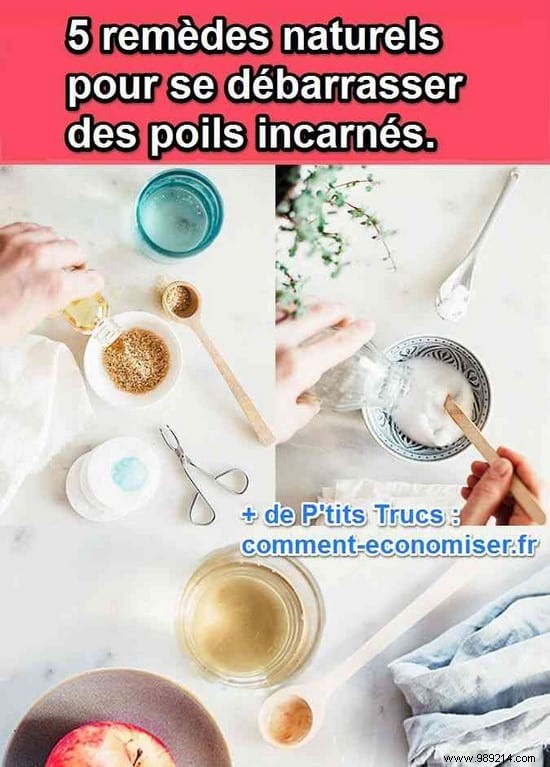 5 Proven Home Remedies to Safely Eliminate Ingrown Hairs