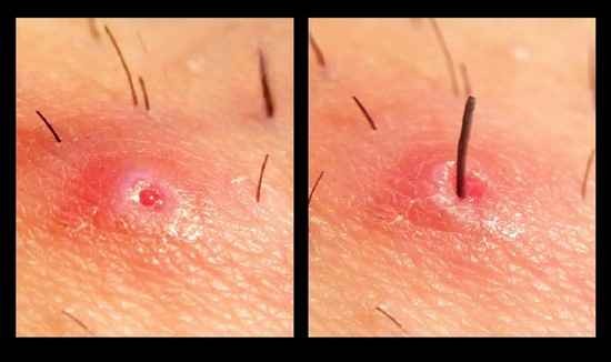 5 Proven Home Remedies to Safely Eliminate Ingrown Hairs