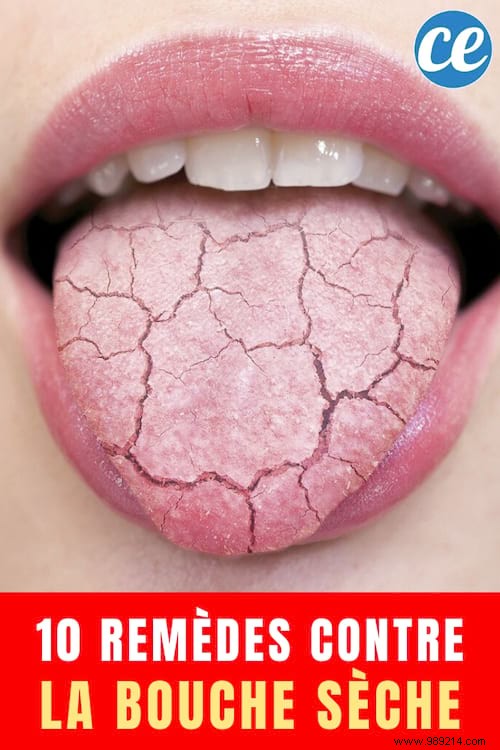 10 Proven Natural Remedies to Relieve Dry Mouth Effectively