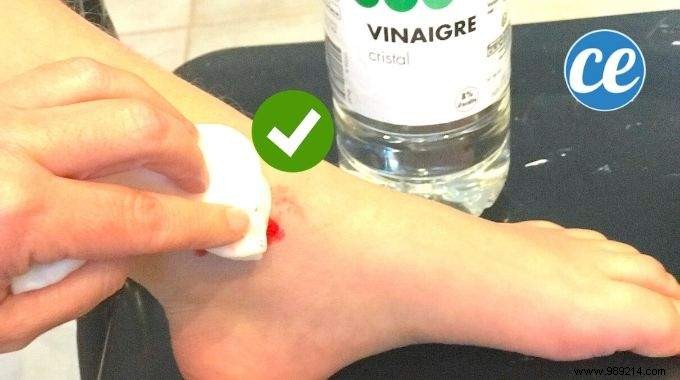Heal Minor Cuts Fast with White Vinegar: A Trusted Home Remedy
