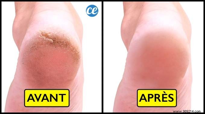 10 Proven Home Remedies for Dry, Cracked Heels: Restore Soft, Smooth Feet Naturally