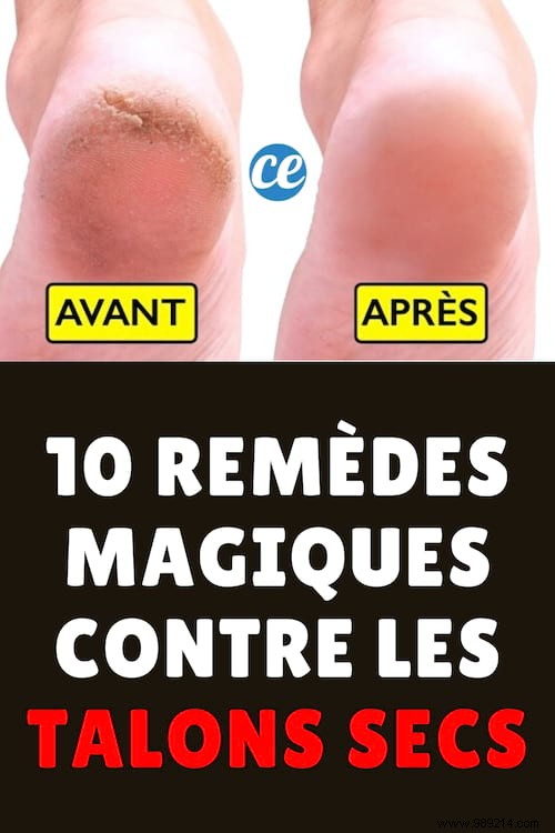 10 Proven Home Remedies for Dry, Cracked Heels: Restore Soft, Smooth Feet Naturally