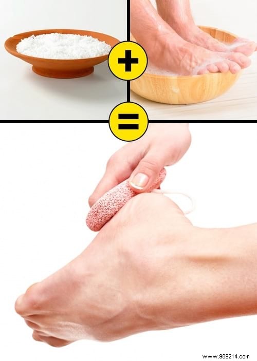 10 Proven Home Remedies for Dry, Cracked Heels: Restore Soft, Smooth Feet Naturally