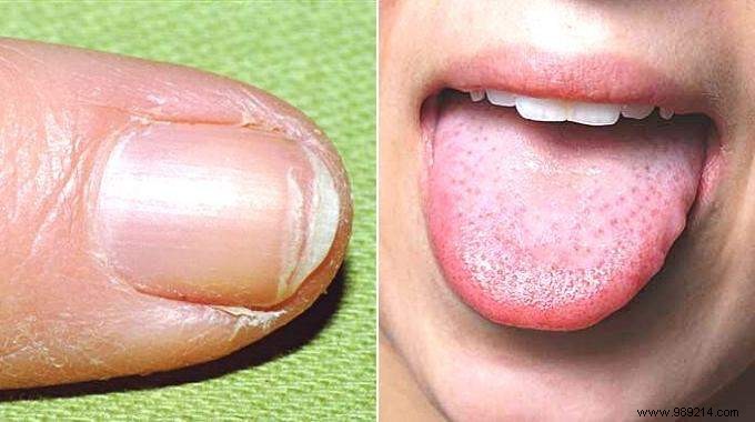 9 Key Signs of Iron Deficiency Anemia and How to Address Them