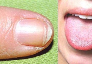 9 Key Signs of Iron Deficiency Anemia and How to Address Them