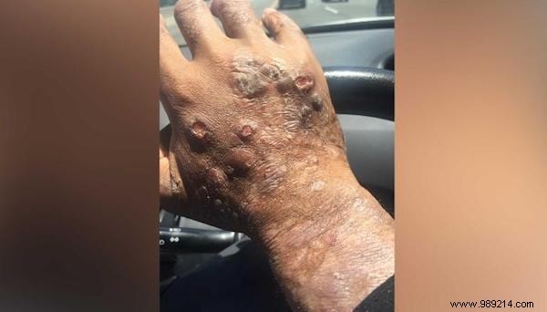 Landmark Glyphosate Verdict: Monsanto Ordered to Pay $289M to Roundup Cancer Victim