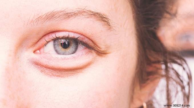 2 Proven Natural Remedies to Reduce Under-Eye Puffiness