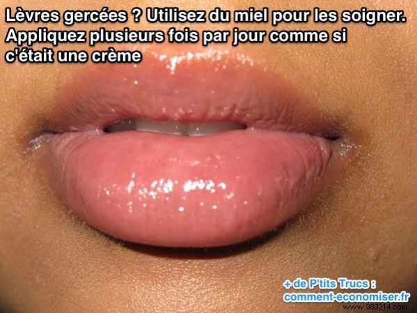 Heal Chapped Lips Naturally: Grandma s Proven Honey Remedy