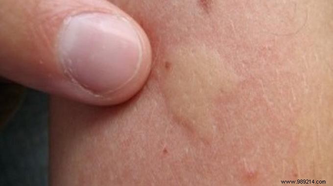 Soothe Itchy Mosquito Bites Naturally with White Vinegar: A Proven Home Remedy