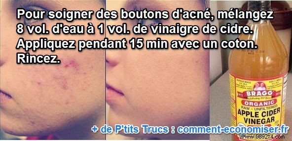 Grandma s Time-Tested Apple Cider Vinegar Remedy for Clear, Acne-Free Skin