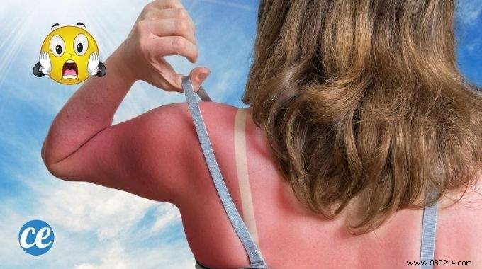 15 Proven Home Remedies to Soothe Sunburn Pain Fast – No Biafine Needed