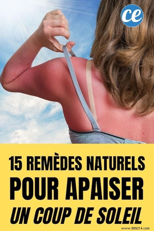 15 Proven Home Remedies to Soothe Sunburn Pain Fast – No Biafine Needed