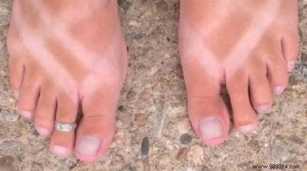 15 Proven Home Remedies to Soothe Sunburn Pain Fast – No Biafine Needed