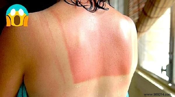15 Proven Home Remedies to Soothe Sunburn Pain Fast – No Biafine Needed