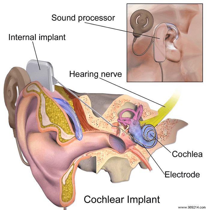 Brain-Computer Interfaces: What They Are and Why They re Captivating the World Now