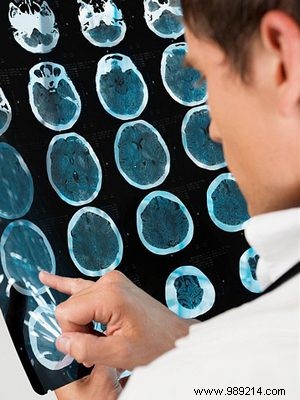 Long-Term Stroke Effects: 70% of Survivors Face Lasting Cognitive and Behavioral Changes