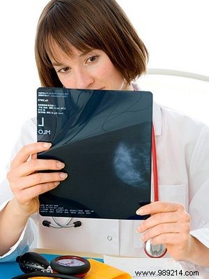 Exemestane Reduces Breast Cancer Risk by 65% in Postmenopausal Women: Landmark Study