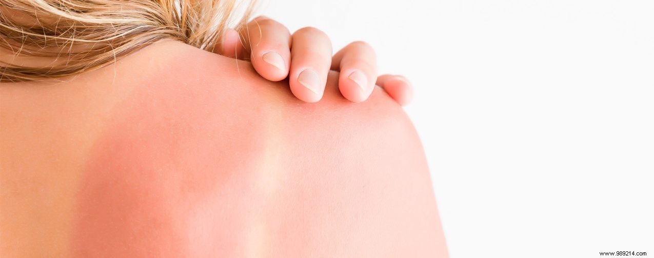 4 Expert Ways to Soothe and Heal Sunburned Skin