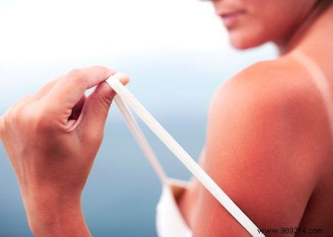 How Does the Sun Burn Your Skin? UV Rays and Sunburn Explained