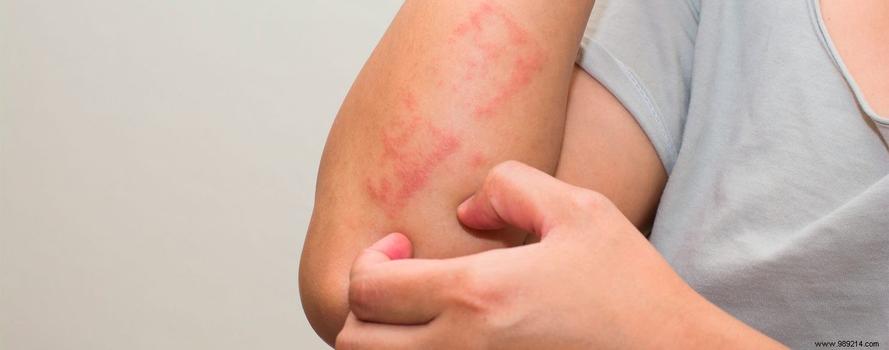 Eczema Flare-Ups in Colder Weather: Expert Prevention and Treatment Tips