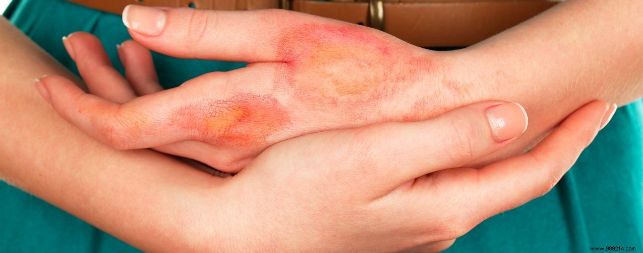 Candle Burn: Can You Treat It Safely at Home? Advice from Pharmacist Linda