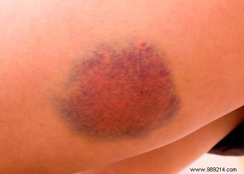 How Do Bruises Form? Why They Show a Rainbow of Colors Before Healing