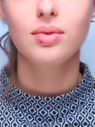 Sun Exposure Triggers Cold Sores—Even Mild Winter Sun