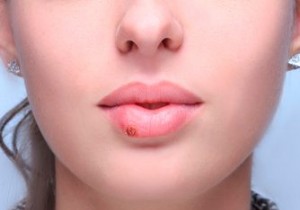 Sun Exposure Triggers Cold Sores—Even Mild Winter Sun