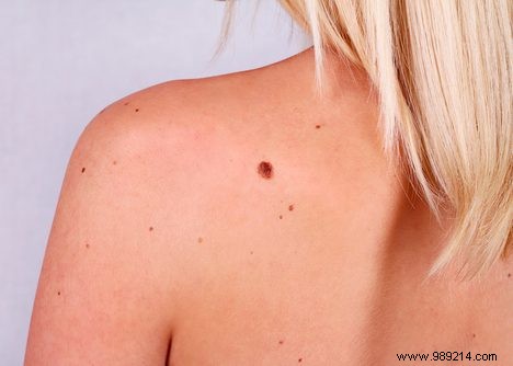 Harvard Study: Few Moles Don t Mean Lower Skin Cancer Risk
