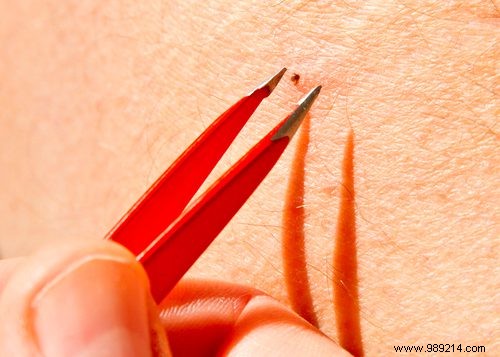 How to Spot a Tick Bite: Essential Signs Beyond the Red Circle