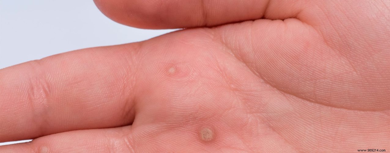 Warts: Expert Guide to Causes, Types, Prevention, and Effective Treatments