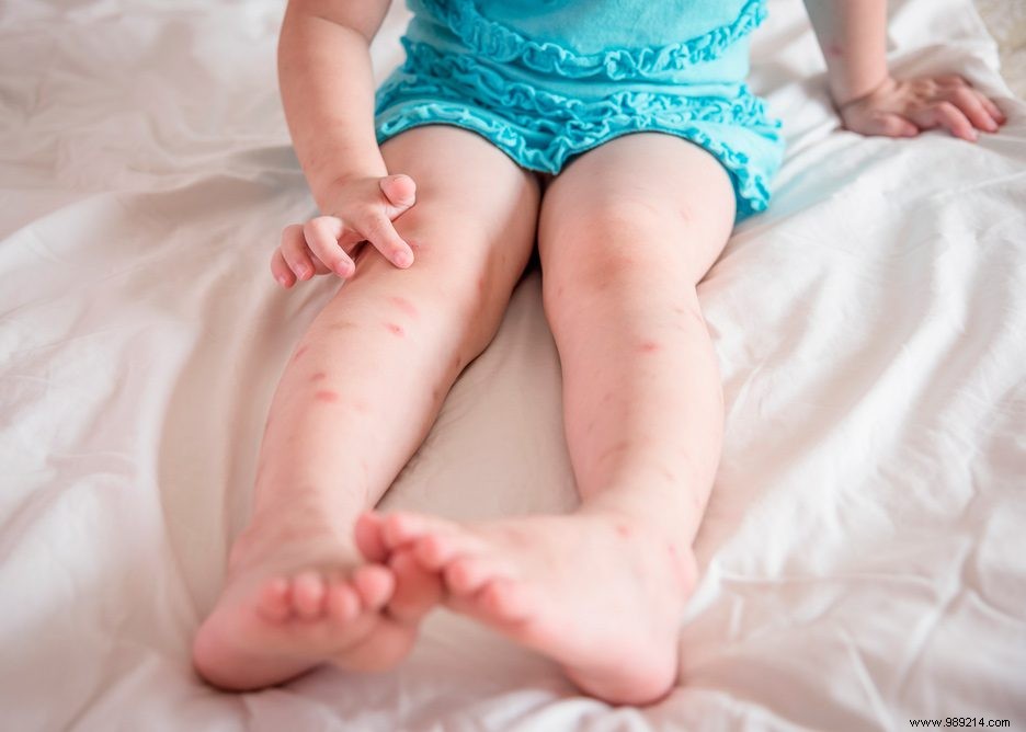 Relieve Mosquito Bite Itch Quickly with Moskinto Plasters