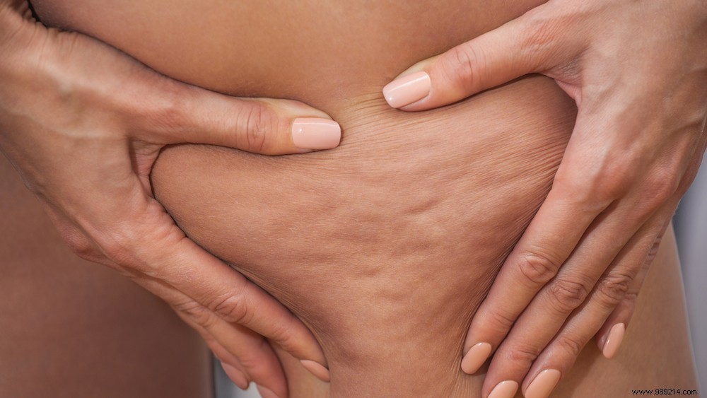 Cellulite vs. Cellulitis: Understanding the Key Differences