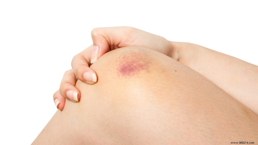 Why Do You Bruise So Easily? 6 Common Causes and When to Worry