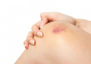 Why Do You Bruise So Easily? 6 Common Causes and When to Worry